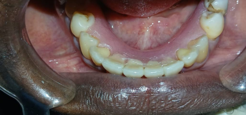 after-Dentures-in-Kampala-Precision-dental-clinic