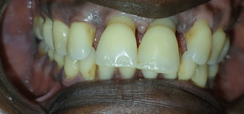 Before braces result 3