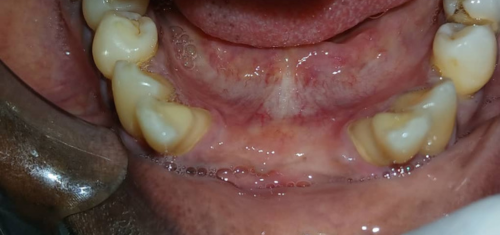 Get your Teeth Fixed with Dentures at Precision Dental