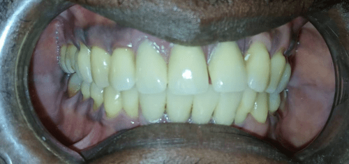 After braces result 3