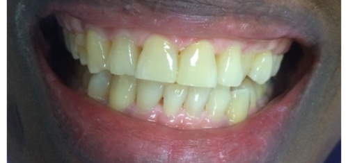 Tooth Filling in Kampala