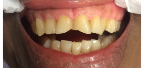 Before Teeth Filling at Precision Dental Clinic