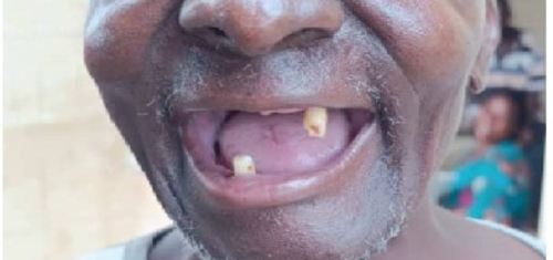 Full-mouth-rehabilitation ,Precision Dental Clinic