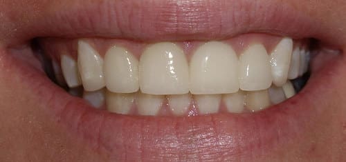 crowns-bonding-after-precision-dental-clinic-kampala