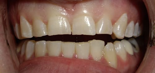 crowns-bonding-before-precision-dental-clinic-kampala