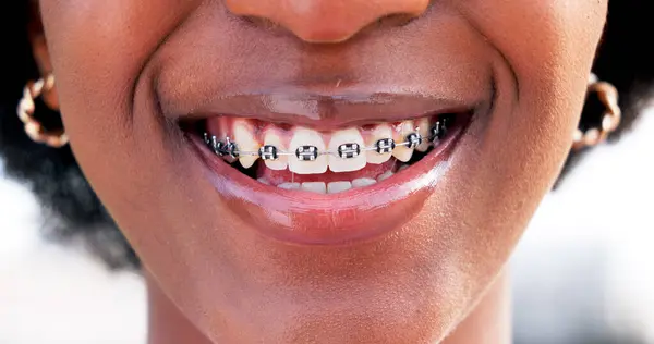 Teeth Alignment with Braces at Precision Dental Clinic Kampala