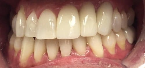 Before braces result 4