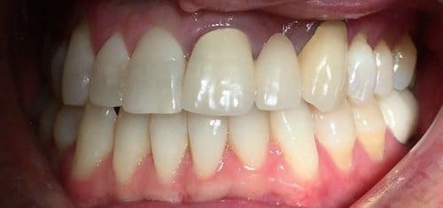 After braces result 4