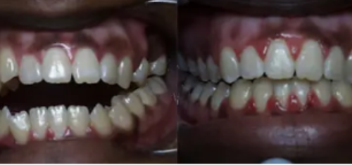 braces-in-kampala