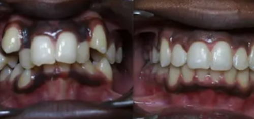 Dental Braces at Precision Dental Clinic