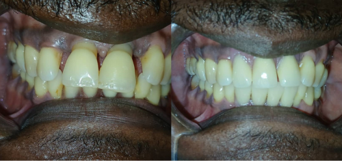 Dental Braces at Precision Dental Clinic