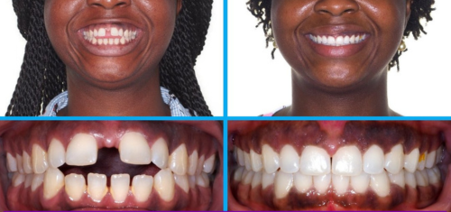 Dental Braces at Precision Dental Clinic