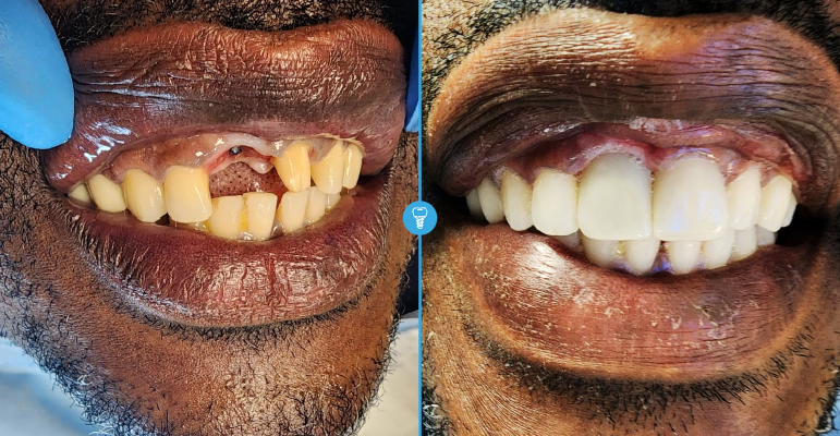 dental Implants in kampala