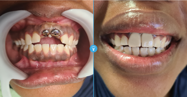 Dental Implants Dental Clinic in Kampala