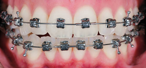 get Braces Near Me