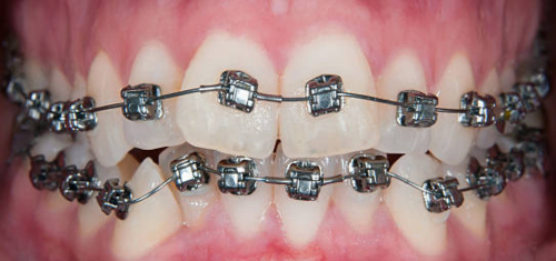 Fix Crooked Teeth Precision Dental Clinic