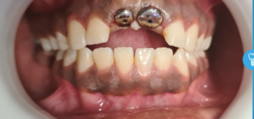 replace missing teeth in kampala