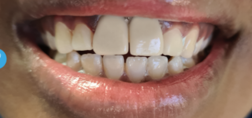 Replace Missing Teeth
