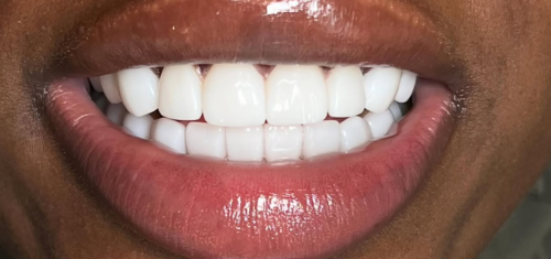 Teeth Whitening dentist in Kampala
