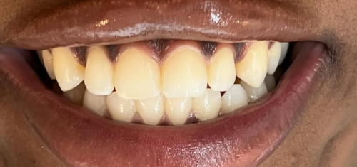 Teeth Whitening In Kampala