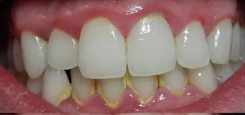 scaling and polishing dentist Kampala