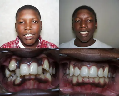 Dental Braces at Precision Dental Clinic Kampala