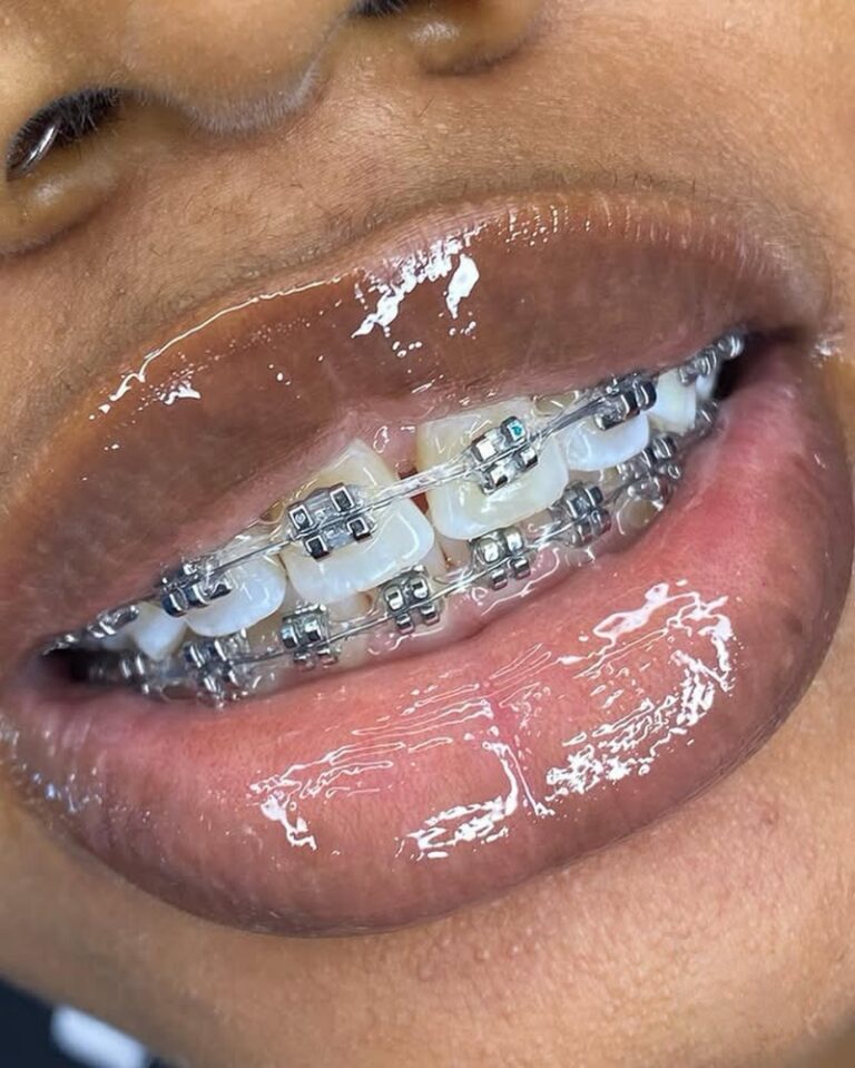 traditional braces