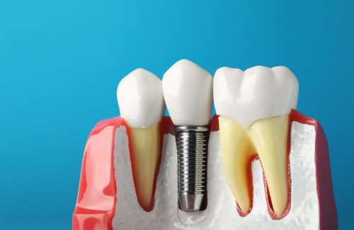 Replace your missing teeth at Precision Dental Clinic