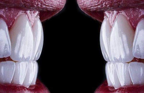Dental Veneers Precision Dental Clinic Kampala