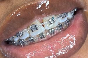 traditional braces