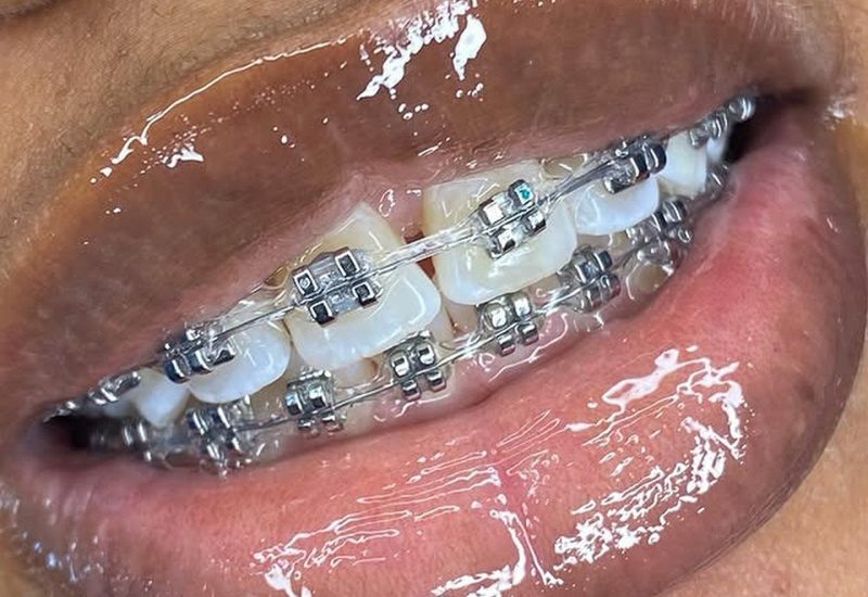 traditional braces