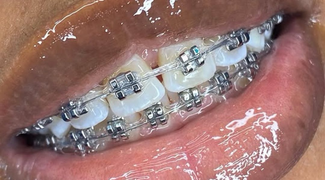 traditional braces