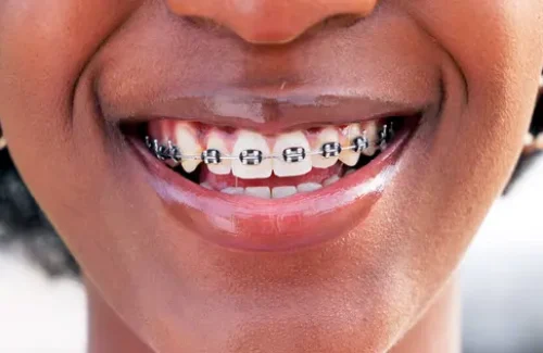 Teeth Alignment with Braces at Precision Dental Clinic Kampala